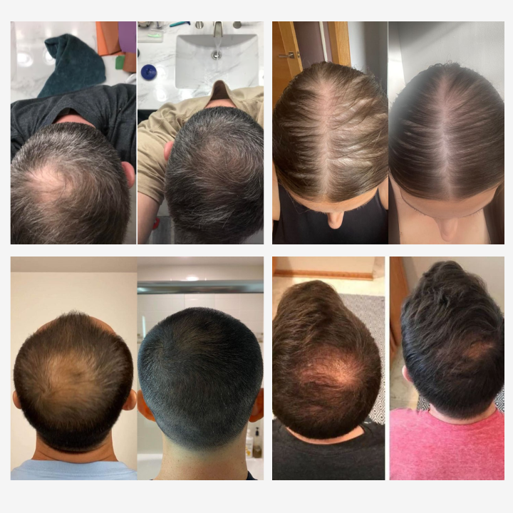 Sérum VÉRA™ - Zastavuje vypadávání vlasů a obnovuje jejich hustotu